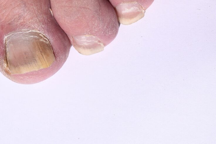 a fase inicial da micose das uñas dos pés