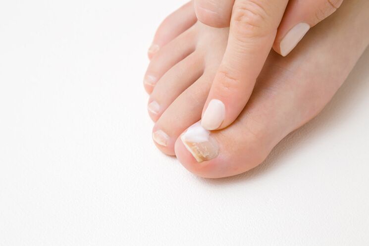 tratamento dos dedos dos pés con pomada para fungos