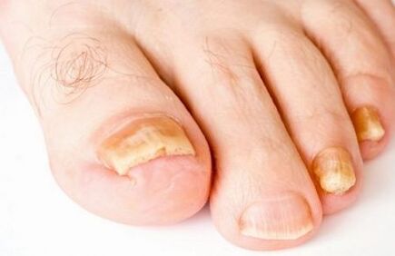 amarelecemento das uñas dos pés con fungo