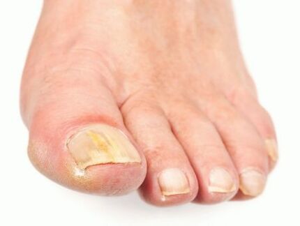 danos nas uñas con fungos nos pés