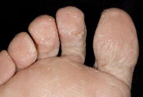 síntomas de fungo na pel dos pés