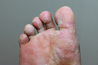 Grave fase de mycosis da pel dos pés
